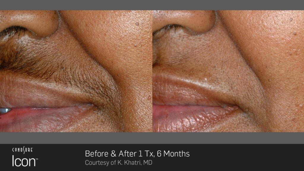 laser hair removal before and after lip