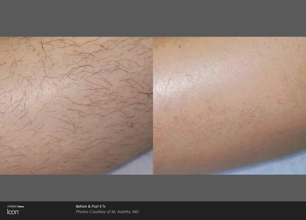laser hair removal before and after leg
