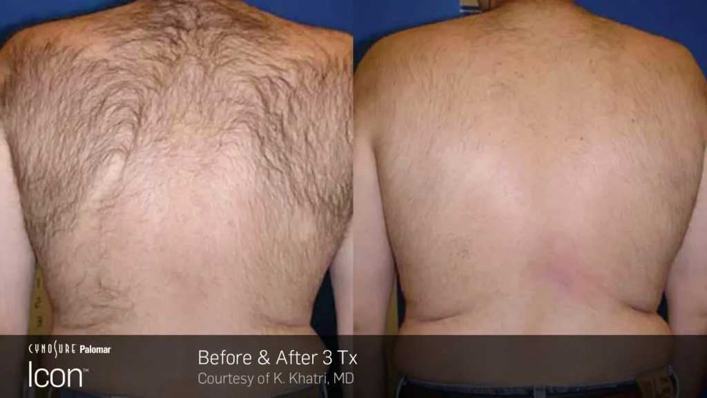 laser hair removal before and after back