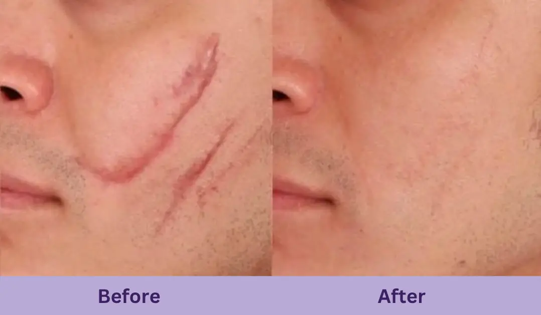 Scar Resurfacing Before & After