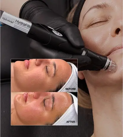 HydraFacial